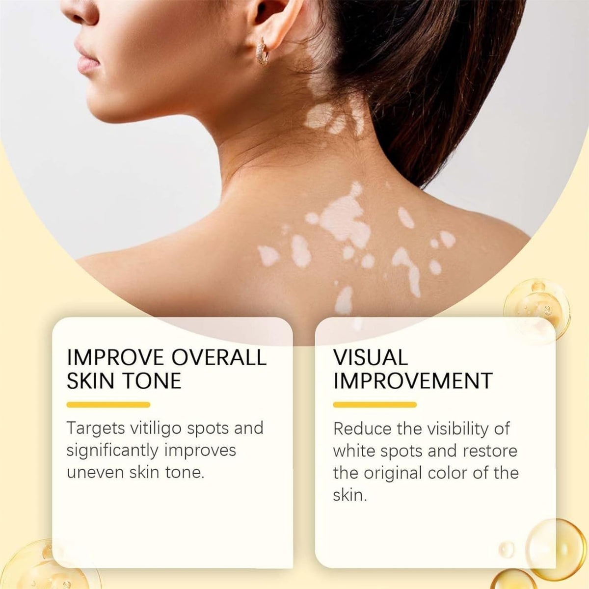 Vitigo Bee Venom Treatment Cream | Natural Skin Repair Hydration Relief Anti-Irritation